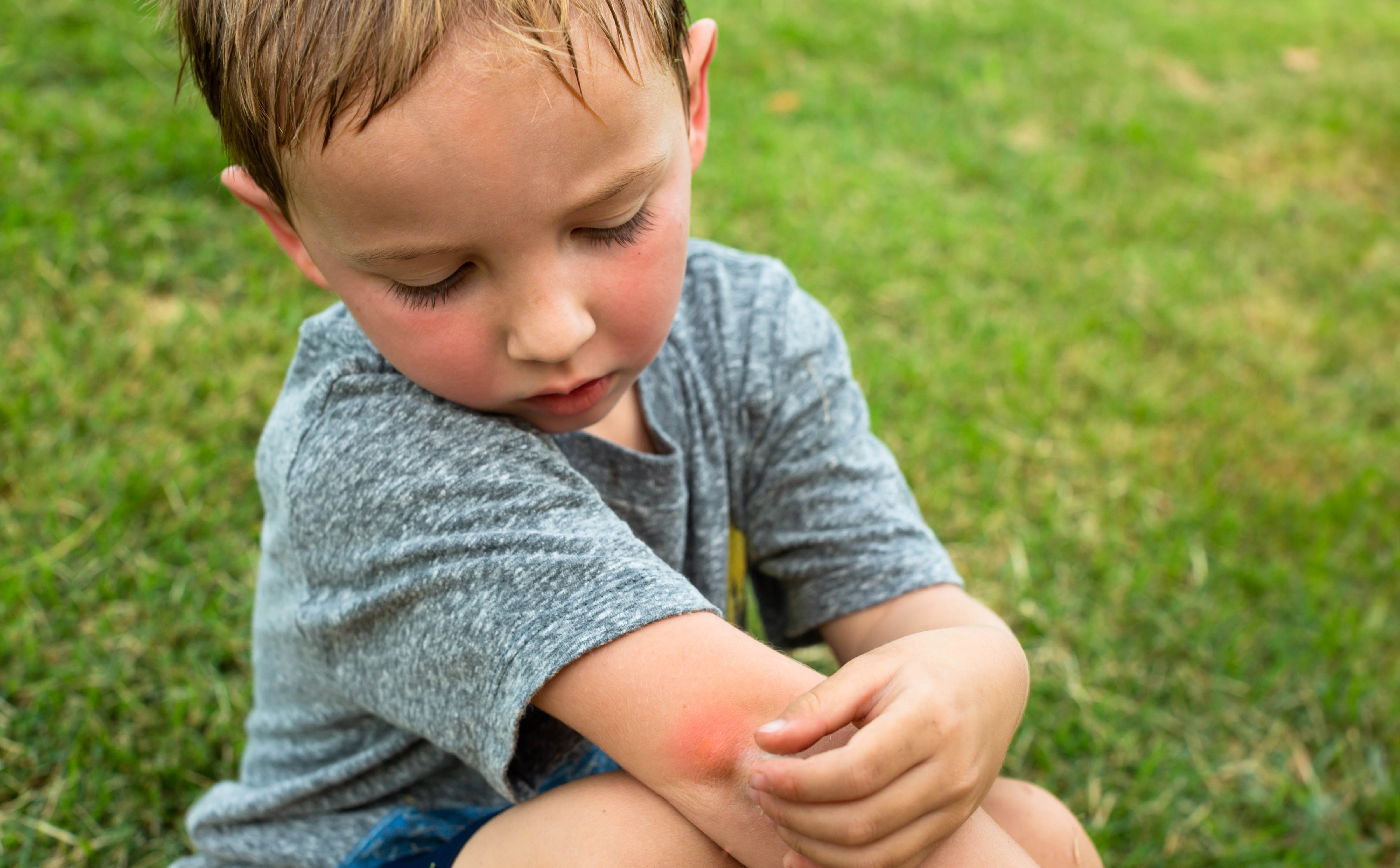 From Sunburn to Stings Natural First Aid for Summer's Injuries